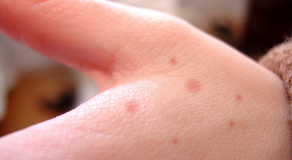 Điều trị vết bọ chét cắn và cách phòng ngừa hiệu quả